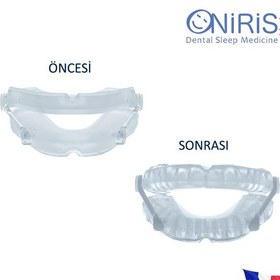Resim Oniris Horlama ve Uyku Apnesi Protezi 