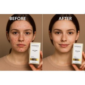 Resim Sanjana Beauty Acne Serum 10 ML 