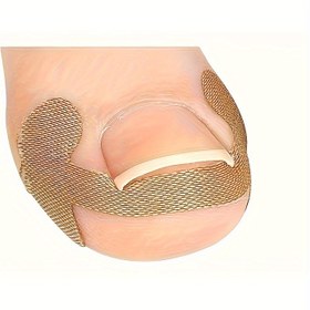 Resim 20 adet / 5 Yaprak Batık Tırnak Düzeltme Bandajı - Yapıştırıcı Gerekmez, Paronikya Tedavisi ve Tırnak Hizalaması için Nefes Alabilen Ağ, Ayarlanabilir Tırnak Bakım Etiketleri 