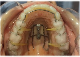 Resim Palatal Power Arm ve Palatal Connector Seti - Power Arm ( PARALEL LARGE) 