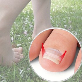 Resim Gözellerinizi daha iyi gösterin! İçe doğru büyüyen tırnaklar için ayak bakım ve tırnak bakımı araçları. Kutulu tırnak çıkartmaları ve tırnak aletleri, parmaklar ve başparmaklar için uygundur 