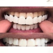 Resim 4 Adet Esnek Beyaz Rahat Diş Koruyucu, Üst ve Alt Aksesuar Setiyle Birlikte - Unisex Kolay Takılabilir Güven Artırıcı Kullanım 