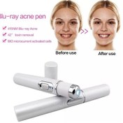 Resim Taşınabilir Kırışıklık Skar Akne Sökücü Cihaz Güçlü Mavi Işık Terapi Kalemi Örümcek Damar Blu-ray Akne Kalem Göz Cilt Bakımı Aracı Dfdf 