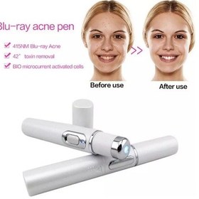 Resim Taşınabilir Kırışıklık Skar Akne Sökücü Cihaz Güçlü Mavi Işık Terapi Kalemi Örümcek Damar Blu-ray Akne Kalem Göz Cilt Bakımı Aracı Dfdf 