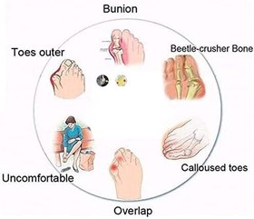 Resim Ayak Kemeri Destekli Kadın Yaz Plaj Ayakkabısı, Yaz Nefes Alabilen Burnu Açık, Konforlu Bunyon Düzeltici, Bunyondan Acı Çeken Kadınlar için Açık Hava Seyahati 