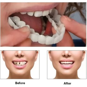 Resim 5 Parça Set: 1 Üst Protez + 1 Alt Protez + 2 Yapışkan Bant + 1 Kutu – Erkekler, Kadınlar ve Gençler İçin Ayarlanabilir Takma Dişler – Rahat, Doğal Görünüm, Kolay Temizlenebilir, Cerrahi Gerektirmez 