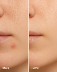 Resim Stopever Clearly Spot Patch, Sivilce Karşıtı Şeffaf Plaster 2'li Paket Ultra İnce, Hidrokolloid + Niacinamide + Salicylic Asit İçerikli Akne Karşıtı Yüz Bandı 48 Adet 2 X 24 