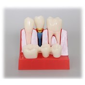 Resim Çıkarılabilir Diş İmplantı Modeli - 4x Taçlı Diş Köprüsü, PVC Malzemeli Diş Eğitimi ve Araştırma Öğretim Modeli, Diş Öğrenimi ve Araştırması için Uygun, Dişçi Dükkanı Sergisi için Uygun 