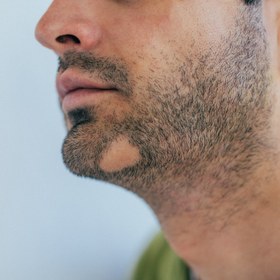 Resim AlopeThol Homogenous Beard System | Sakal Yoğunluk ve Bölgesel Destek Protokolü 