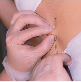 Resim Piercing Delim İğnesi 1.7 Mm Gri Steril Tek Kullanımlık Anjiokat 5 Adet Göbek, Dil Delimi 