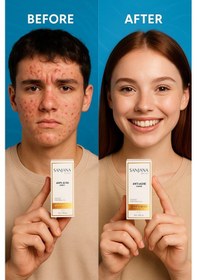 Resim Sanjana Beauty Acne Serum 10 ML 