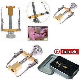 Resim Batık Tırnak Düzeltme Batık Tırnak Çıkarıcı Aparat 