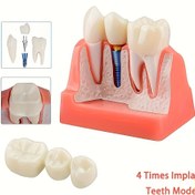 Resim Hareketli Diş İmplant Modeli - 4x Köprü, PVC Malzeme, Eğitim ve Araştırma Kullanımı İçin İdeal, Diş Mağazalarında Sergilemek İçin Mükemmel 