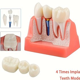 Resim Hareketli Diş İmplant Modeli - 4x Köprü, PVC Malzeme, Eğitim ve Araştırma Kullanımı İçin İdeal, Diş Mağazalarında Sergilemek İçin Mükemmel 