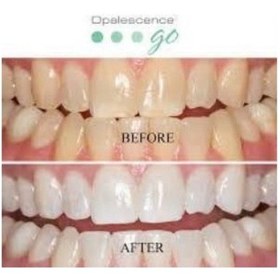 Resim Opalescence Ultradent Go Hazır Kalıp Nane Diş Beyazlatma 8'li 